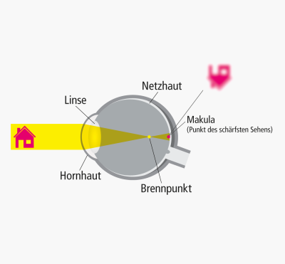Bild zu Ursachen: Wie entsteht Kurzsichtigkeit (Myopie)?