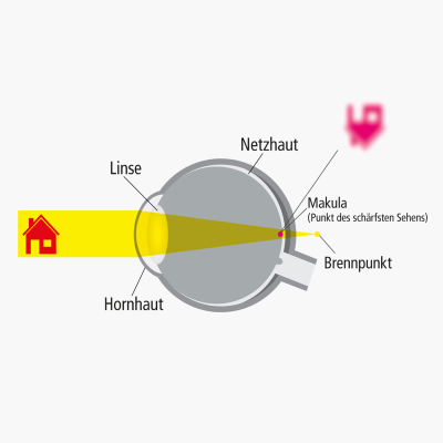 Bild zu Ursachen: Wie entsteht Weitsichtigkeit (Hyperopie)?