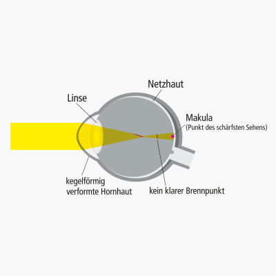 Bild zu Ursachen für Keratokonus (Hornhautkegel)