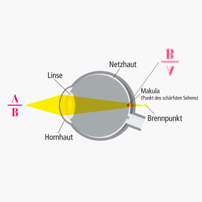 Bild zu Ursachen: Wie entsteht Alterssichtigkeit (Presbyopie)?