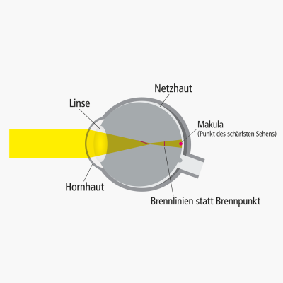 Bild zu Ursachen für Hornhautverkrümmung (Astigmatismus)